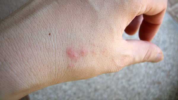 چند حقیقت درباره حشره ساس
